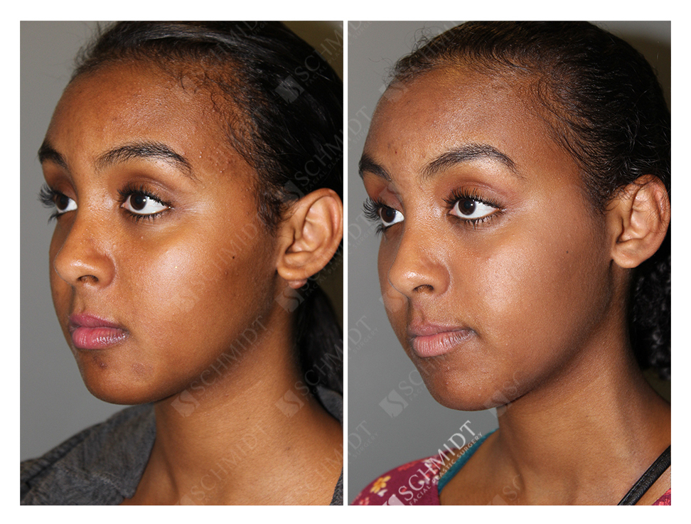 6325 - Schmidt Facial Plastic Surgery