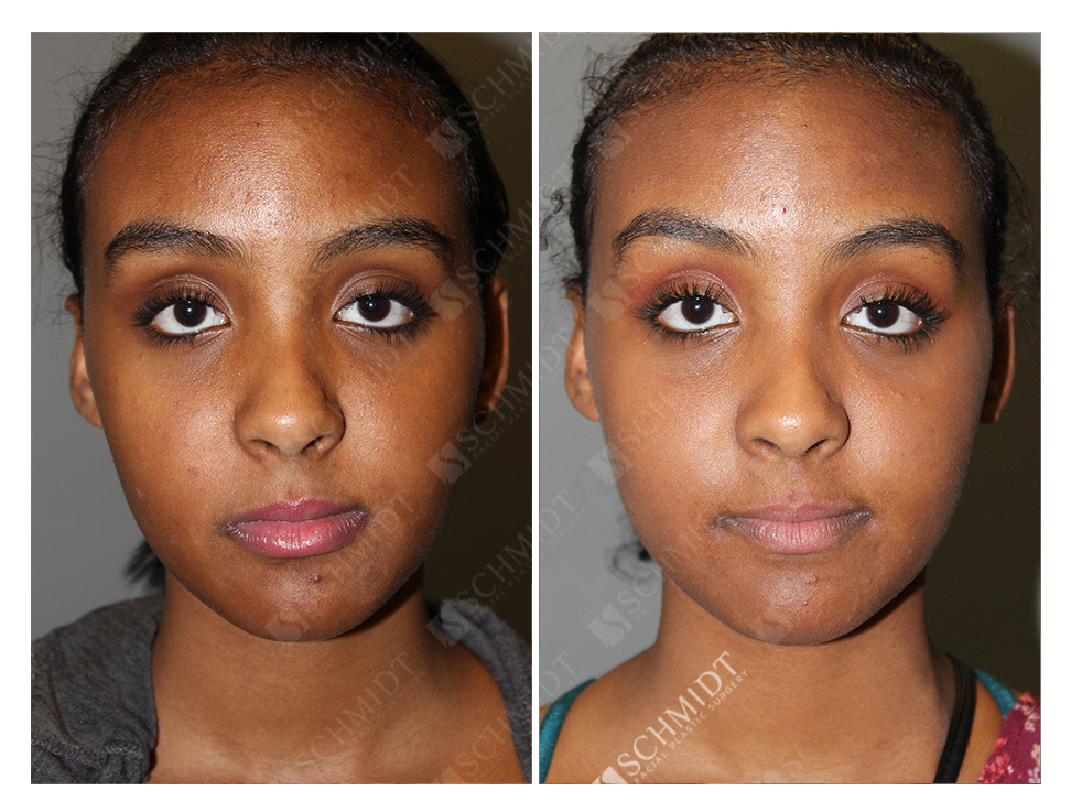 6325 - Schmidt Facial Plastic Surgery