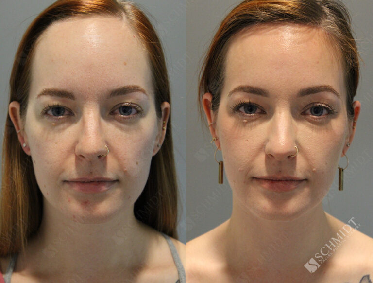 Forehead Reduction Archives - Schmidt Facial Plastic Surgery